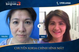 Hình ảnh cắt mí trước sau thẩm mỹ Kangnam - Ca 20