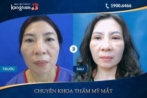 Hình ảnh cắt mí trước sau thẩm mỹ Kangnam - Ca 21