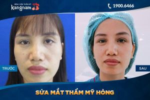 Hình ảnh cắt mí trước sau thẩm mỹ Kangnam - Ca 22