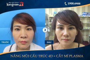 Hình ảnh cắt mí trước sau thẩm mỹ Kangnam - Ca 23