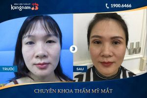 Hình ảnh cắt mí trước sau thẩm mỹ Kangnam - Ca 24