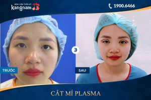 Hình ảnh cắt mí trước sau thẩm mỹ Kangnam - Ca 25