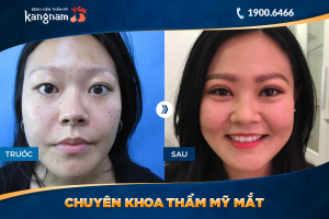 Hình ảnh cắt mí trước sau thẩm mỹ Kangnam - Ca 26