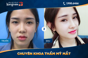 Hình ảnh cắt mí trước sau thẩm mỹ Kangnam - Ca 27