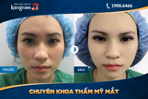 Hình ảnh cắt mí trước sau thẩm mỹ Kangnam - Ca 28