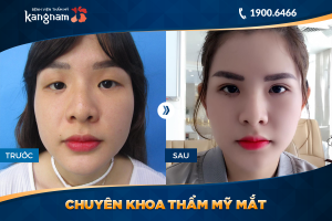 Hình ảnh cắt mí trước sau thẩm mỹ Kangnam - Ca 29