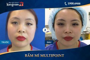 Hình ảnh cắt mí trước sau thẩm mỹ Kangnam - Ca 3