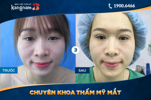 Hình ảnh cắt mí trước sau thẩm mỹ Kangnam - Ca 30