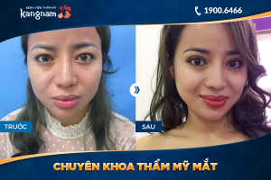 Hình ảnh cắt mí trước sau thẩm mỹ Kangnam - Ca 31