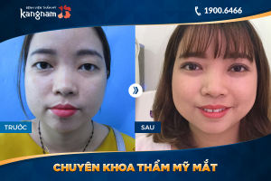 Hình ảnh cắt mí trước sau thẩm mỹ Kangnam - Ca 33