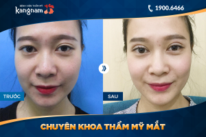 Hình ảnh cắt mí trước sau thẩm mỹ Kangnam - Ca 34