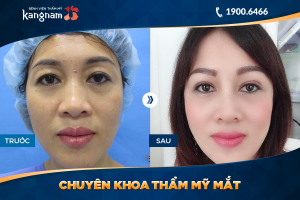 Hình ảnh cắt mí trước sau thẩm mỹ Kangnam - Ca 35