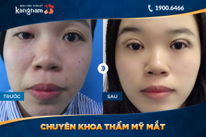 Hình ảnh cắt mí trước sau thẩm mỹ Kangnam - Ca 36