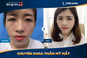 Hình ảnh cắt mí trước sau thẩm mỹ Kangnam - Ca 37