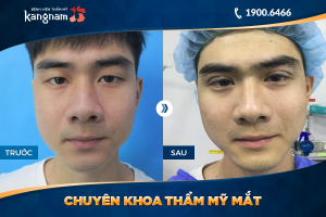 Hình ảnh cắt mí trước sau thẩm mỹ Kangnam - Ca 38