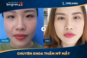Hình ảnh cắt mí trước sau thẩm mỹ Kangnam - Ca 39