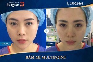 Hình ảnh cắt mí trước sau thẩm mỹ Kangnam - Ca 4