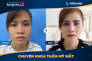 Hình ảnh cắt mí trước sau thẩm mỹ Kangnam - Ca 40