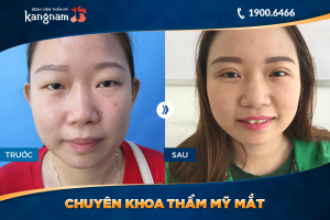 Hình ảnh cắt mí trước sau thẩm mỹ Kangnam - Ca 41