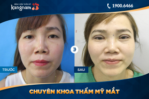 Hình ảnh cắt mí trước sau thẩm mỹ Kangnam - Ca 42