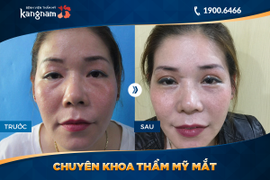 Hình ảnh cắt mí trước sau thẩm mỹ Kangnam - Ca 43