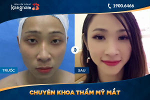 Hình ảnh cắt mí trước sau thẩm mỹ Kangnam - Ca 44