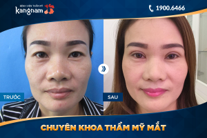 Hình ảnh cắt mí trước sau thẩm mỹ Kangnam - Ca 45