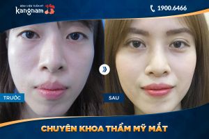 Hình ảnh cắt mí trước sau thẩm mỹ Kangnam - Ca 46