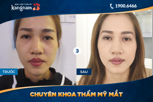 Hình ảnh cắt mí trước sau thẩm mỹ Kangnam - Ca 47