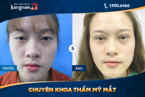 Hình ảnh cắt mí trước sau thẩm mỹ Kangnam - Ca 49