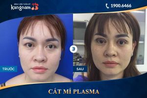 Hình ảnh cắt mí trước sau thẩm mỹ Kangnam - Ca 5