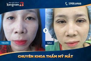 Hình ảnh cắt mí trước sau thẩm mỹ Kangnam - Ca 50