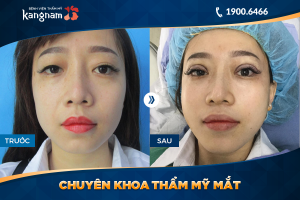 Hình ảnh cắt mí trước sau thẩm mỹ Kangnam - Ca 51