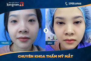 Hình ảnh cắt mí trước sau thẩm mỹ Kangnam - Ca 52