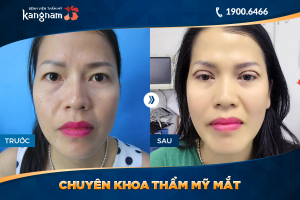 Hình ảnh cắt mí trước sau thẩm mỹ Kangnam - Ca 53