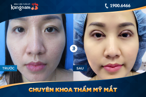 Hình ảnh cắt mí trước sau thẩm mỹ Kangnam - Ca 54