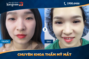 Hình ảnh cắt mí trước sau thẩm mỹ Kangnam - Ca 55