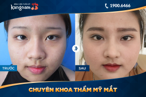 Hình ảnh cắt mí trước sau thẩm mỹ Kangnam - Ca 56
