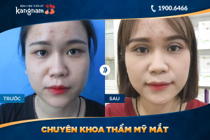 Hình ảnh cắt mí trước sau thẩm mỹ Kangnam - Ca 57