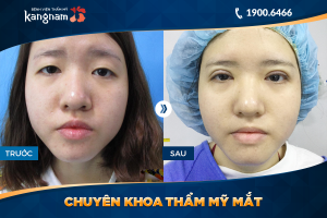 Hình ảnh cắt mí trước sau thẩm mỹ Kangnam - Ca 58