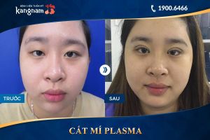 Hình ảnh cắt mí trước sau thẩm mỹ Kangnam - Ca 6