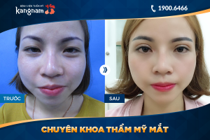 Hình ảnh cắt mí trước sau thẩm mỹ Kangnam - Ca 60