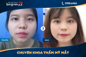 Hình ảnh cắt mí trước sau thẩm mỹ Kangnam - Ca 61
