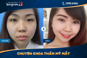 Hình ảnh cắt mí trước sau thẩm mỹ Kangnam - Ca 62