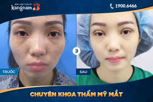 Hình ảnh cắt mí trước sau thẩm mỹ Kangnam - Ca 65