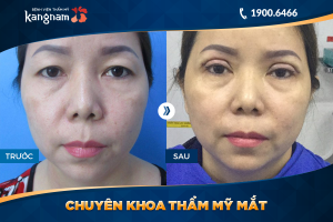 Hình ảnh cắt mí trước sau thẩm mỹ Kangnam - Ca 66