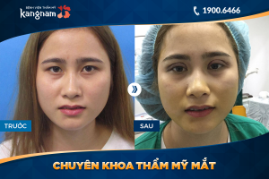 Hình ảnh cắt mí trước sau thẩm mỹ Kangnam - Ca 67