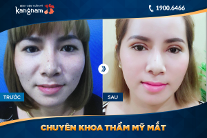 Hình ảnh cắt mí trước sau thẩm mỹ Kangnam - Ca 68