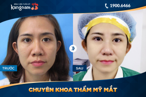 Hình ảnh cắt mí trước sau thẩm mỹ Kangnam - Ca 69