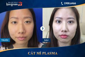 Hình ảnh cắt mí trước sau thẩm mỹ Kangnam - Ca 7